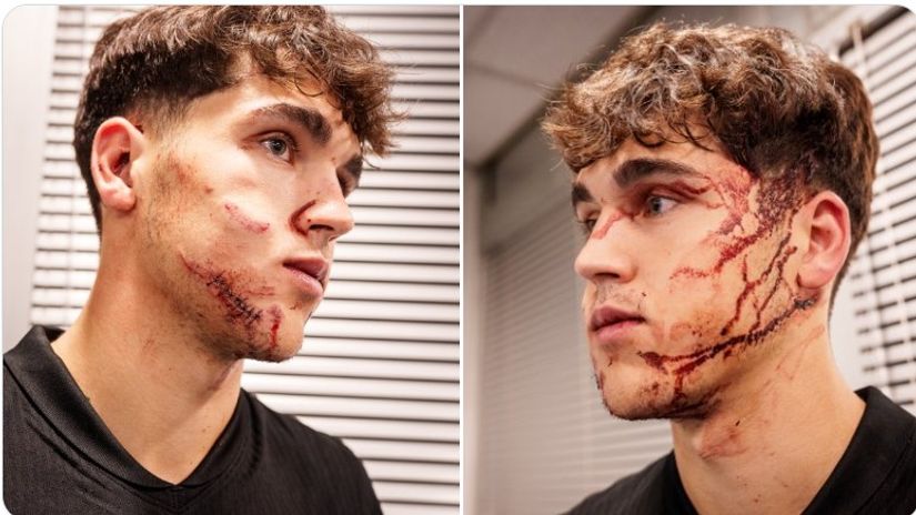 Stitches all over Cubarsi's face (©X/FC Barcelona)